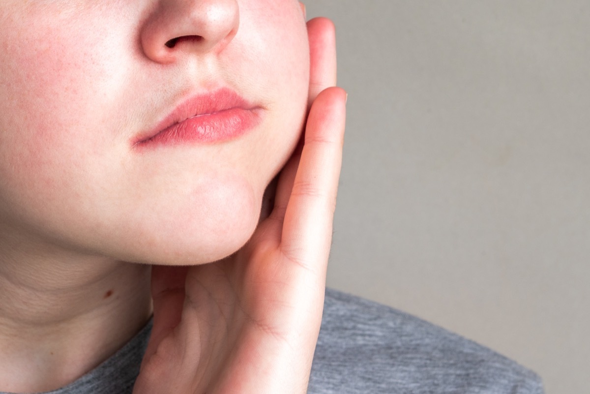 Woman with swollen cheeks