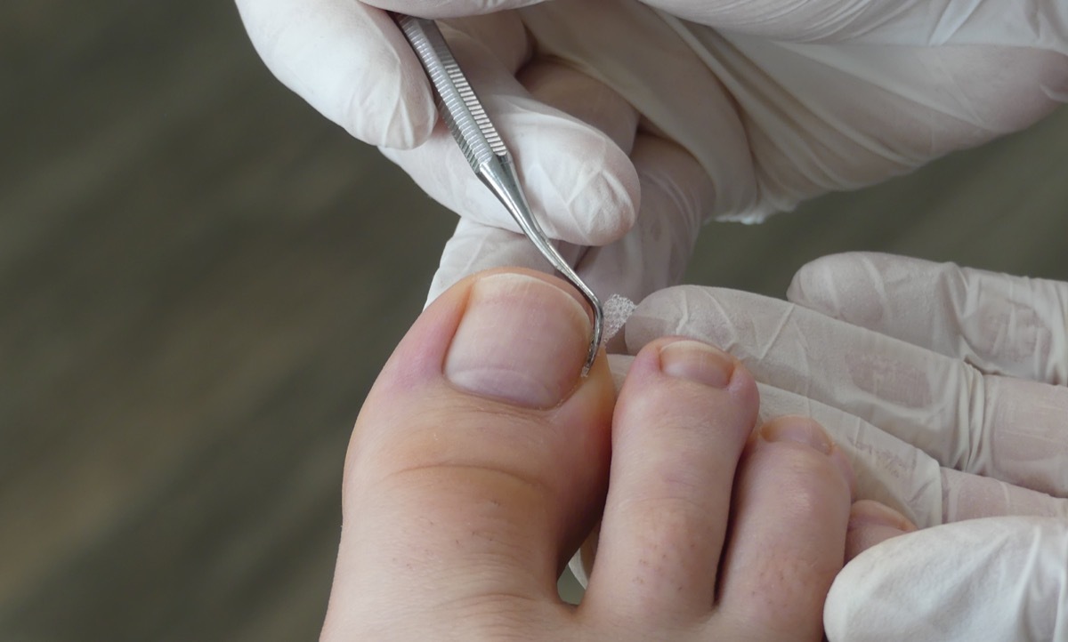 Podiatry, Chiropodist, medical foot care, podiatrist, ingrown toenail, fix an ingrown toenail