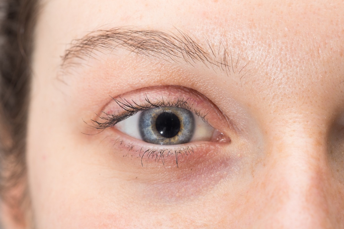 Woman with dilated pupils