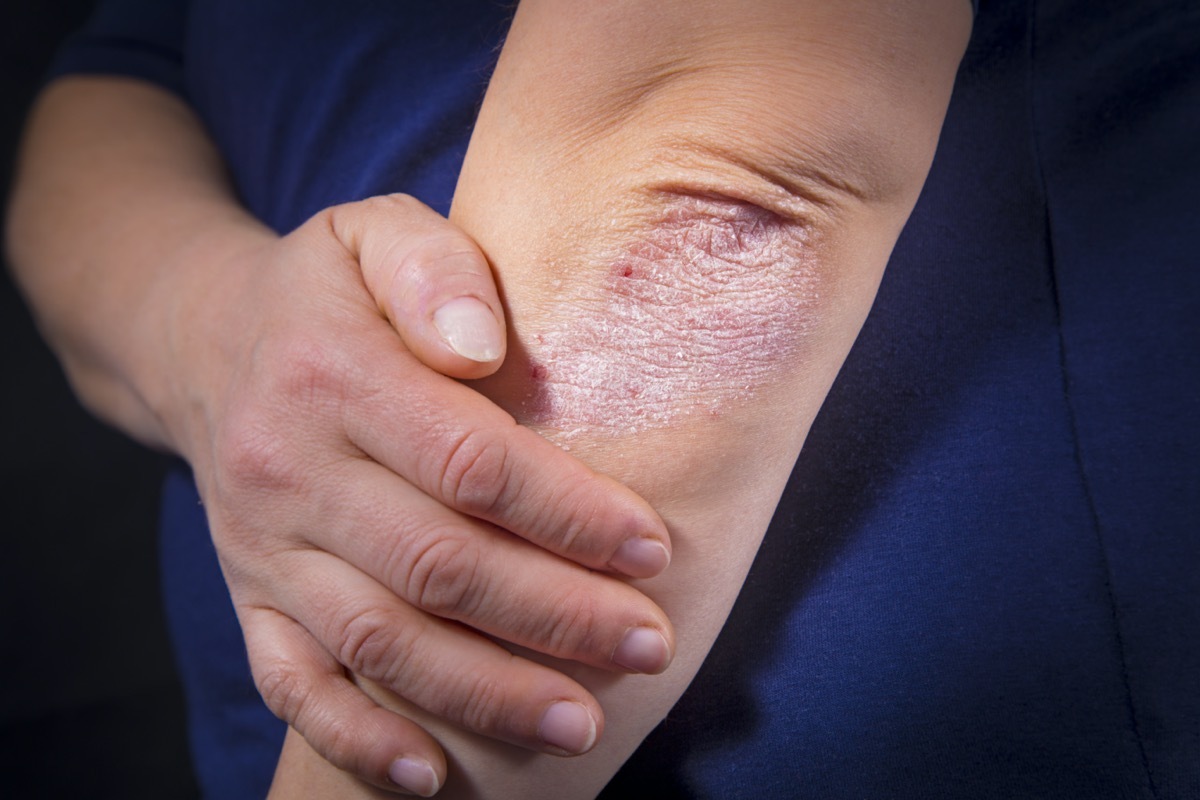 Psoriasis on lady's elbow on dark background