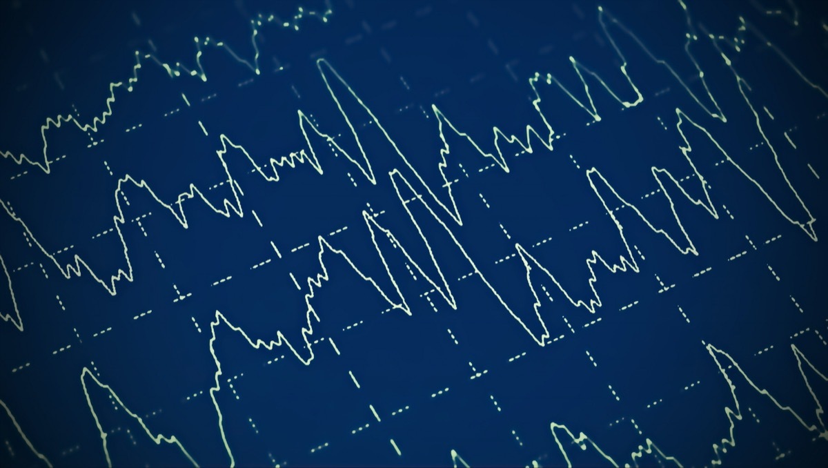 Brain wave on electroencephalogram EEG for epilepsy