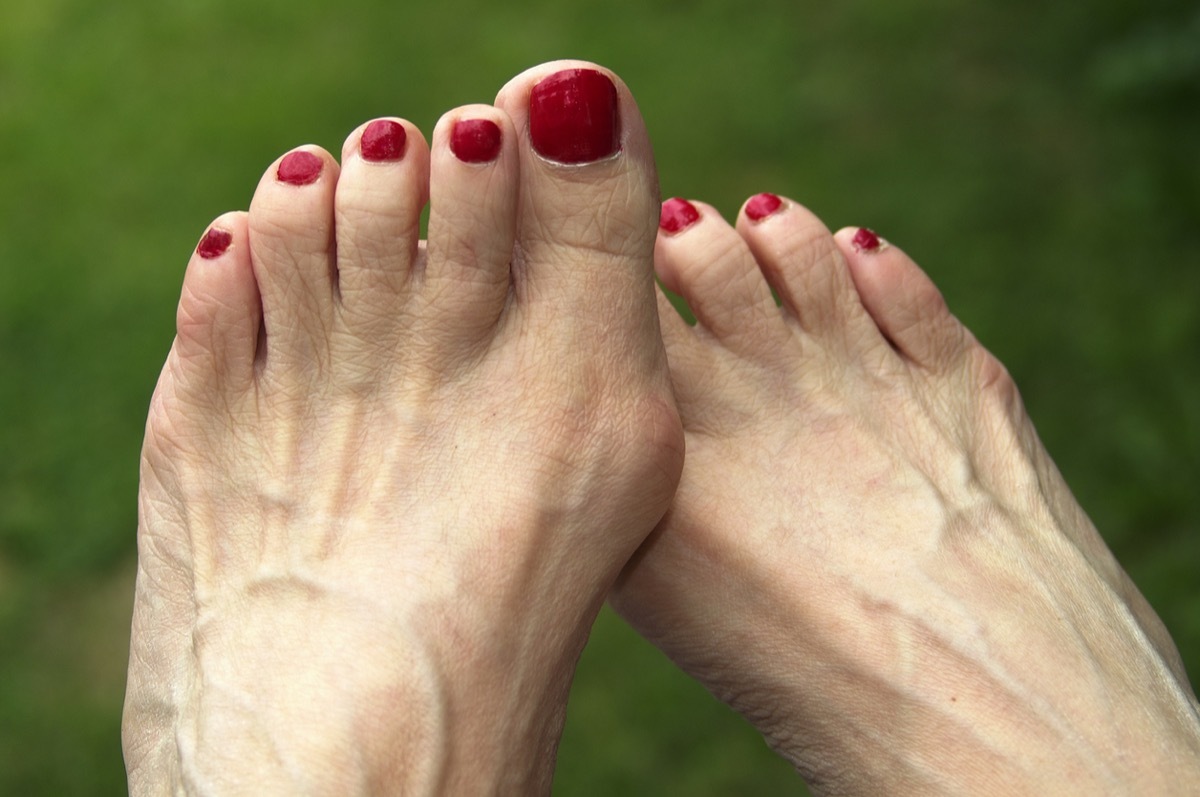 Feet with Bunions