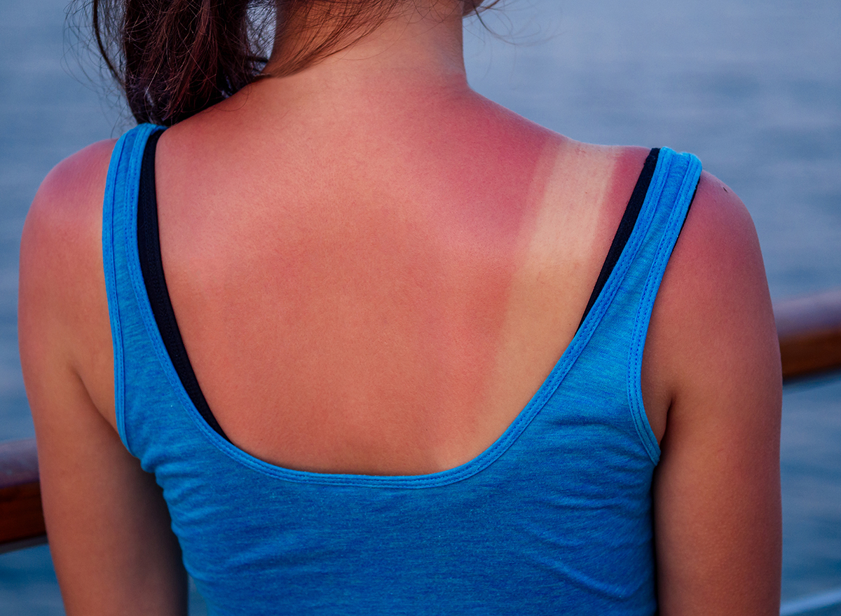 a woman's sun burned back