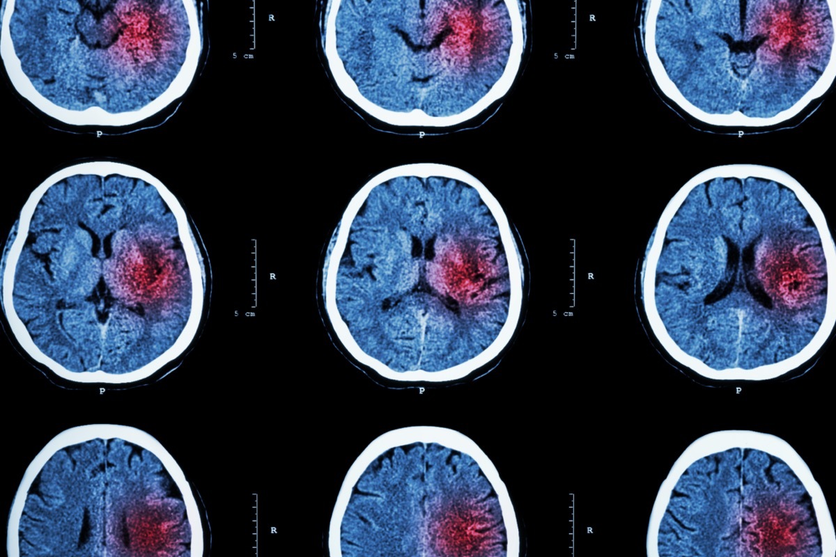 CT scan of brain with red area for hemorrhagic stroke