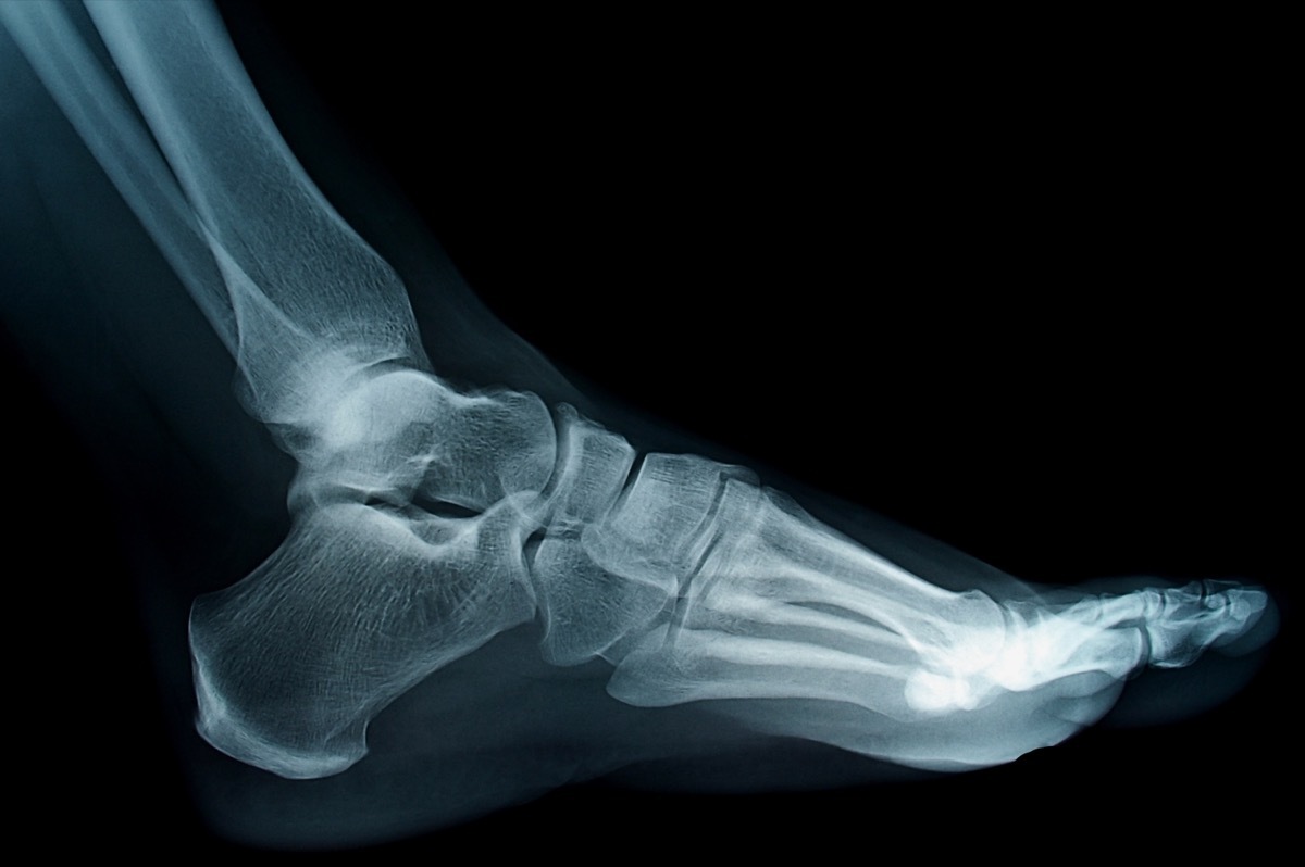 x-ray of a foot