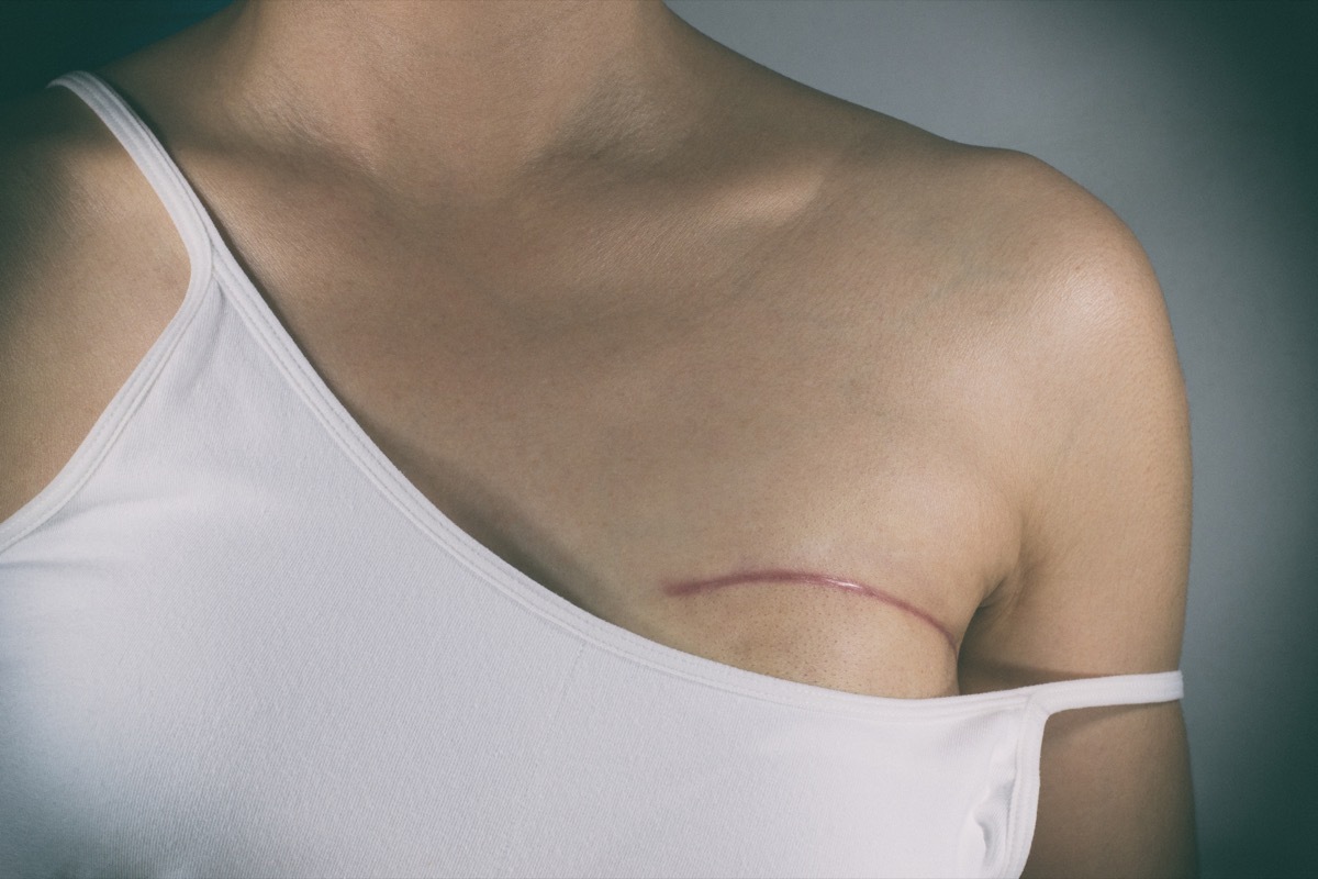 Breast cancer surgery scars by partial mastectomy. With effect filter.