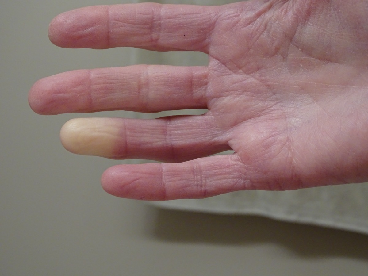 Adult hand with Raynaud's Syndrome