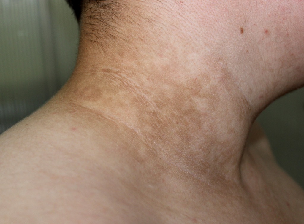 Discoloration of the Skin From Diabetes surprising symptoms