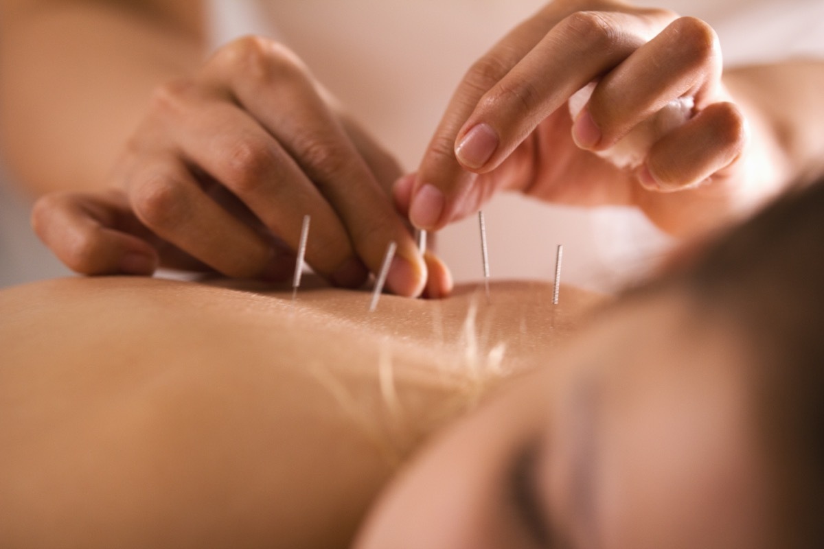 woman getting acupuncture to her back. 