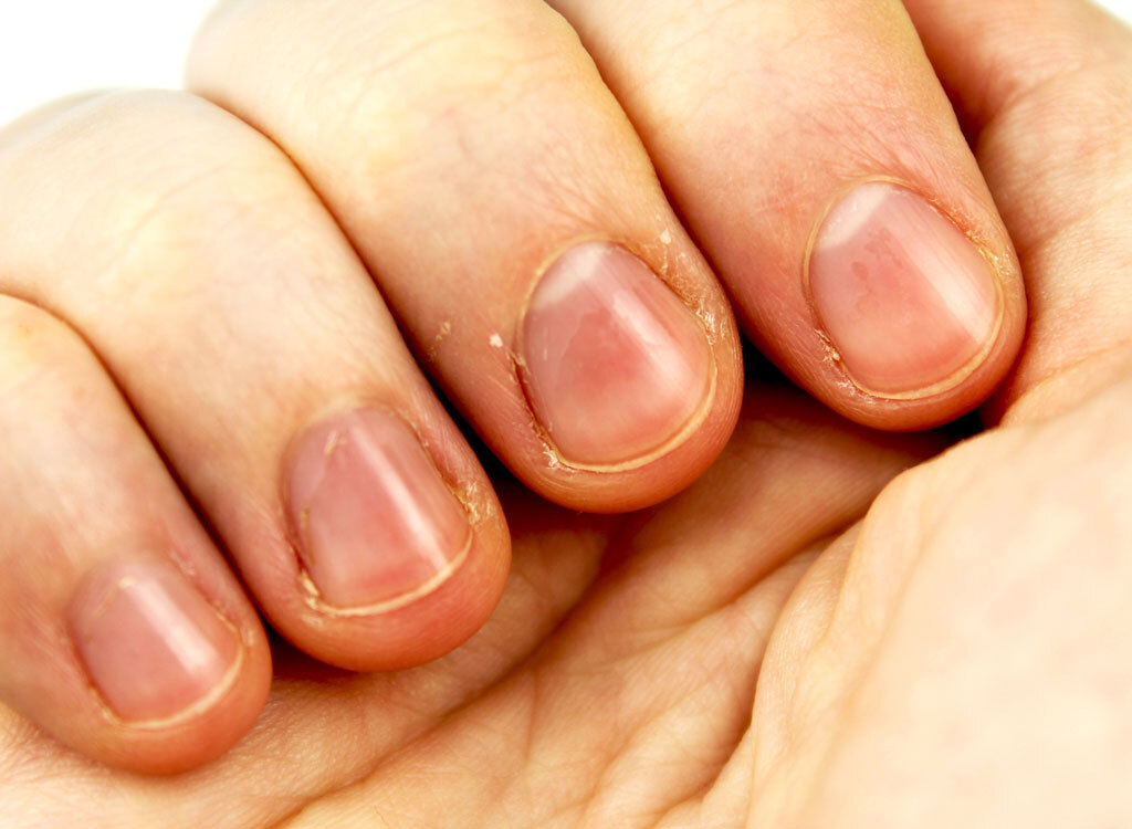 Hand with brittle nails.